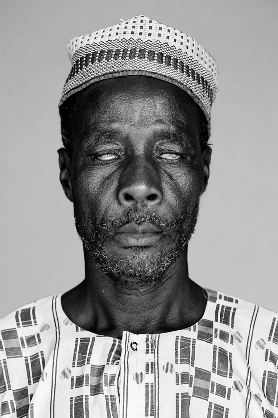 Marcus Trappaud Bjorn и его фотопроект "Африка; Речная слепота"